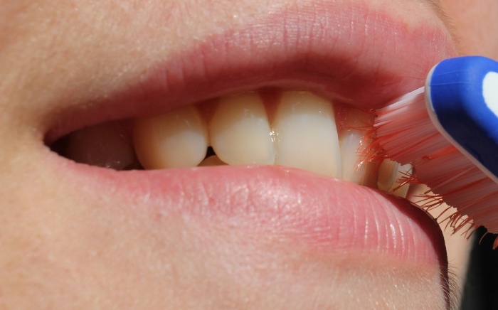 Getting Dental Implants