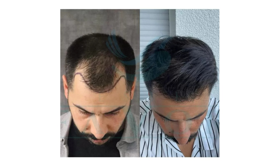 Best Hair Transplant Clinics In Turkey